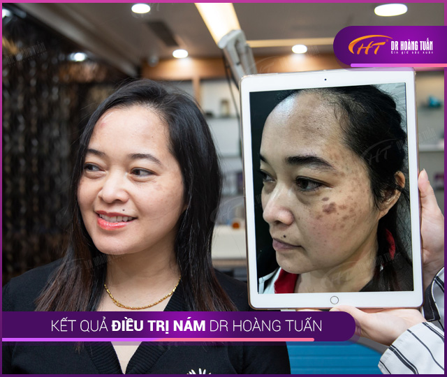 Kết quả điều trị tại Thẩm mỹ Hoàng Tuấn